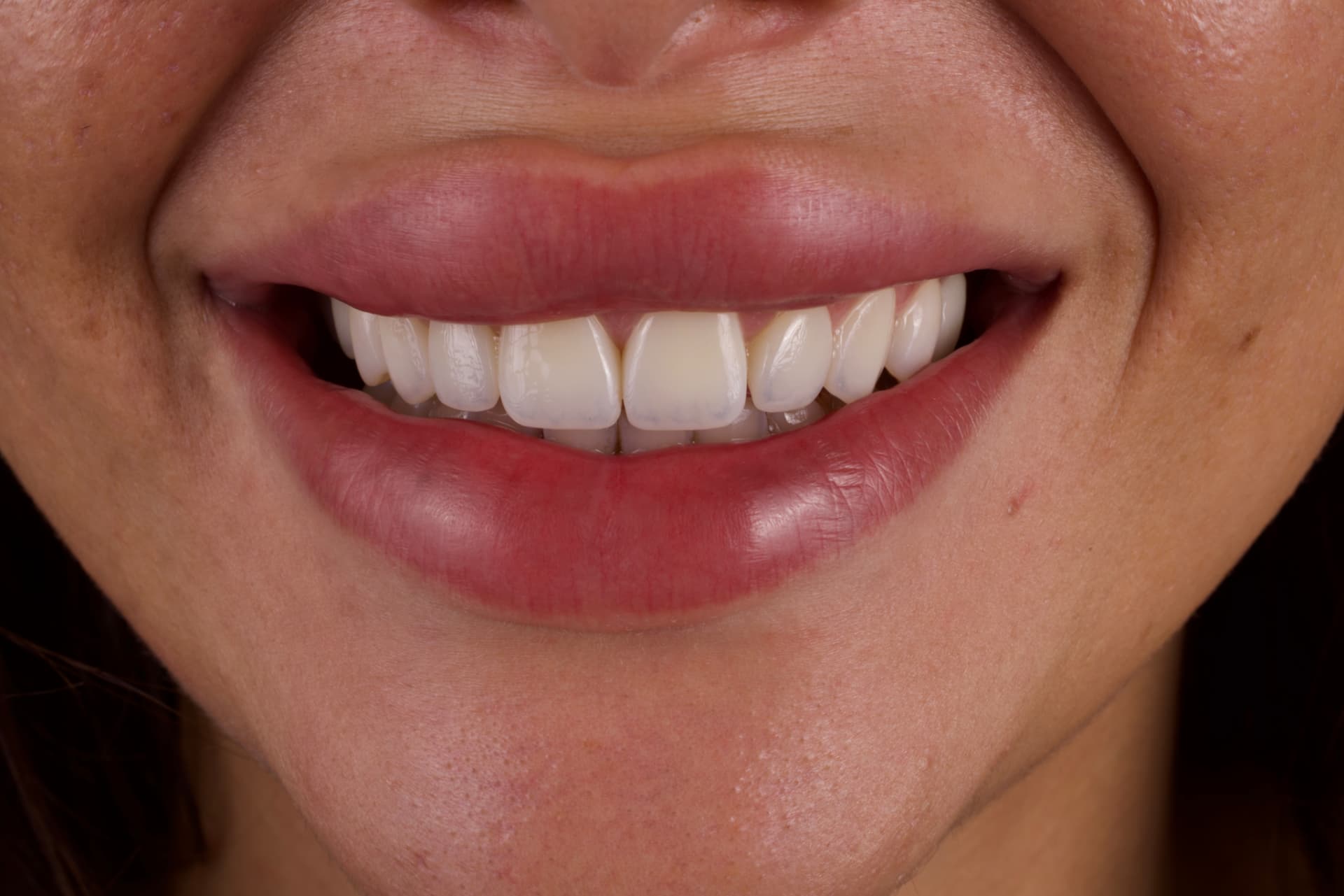 Sourire après harmonisation esthétique